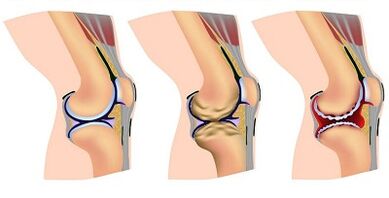 Stages of development of arthrosis of the knee joint